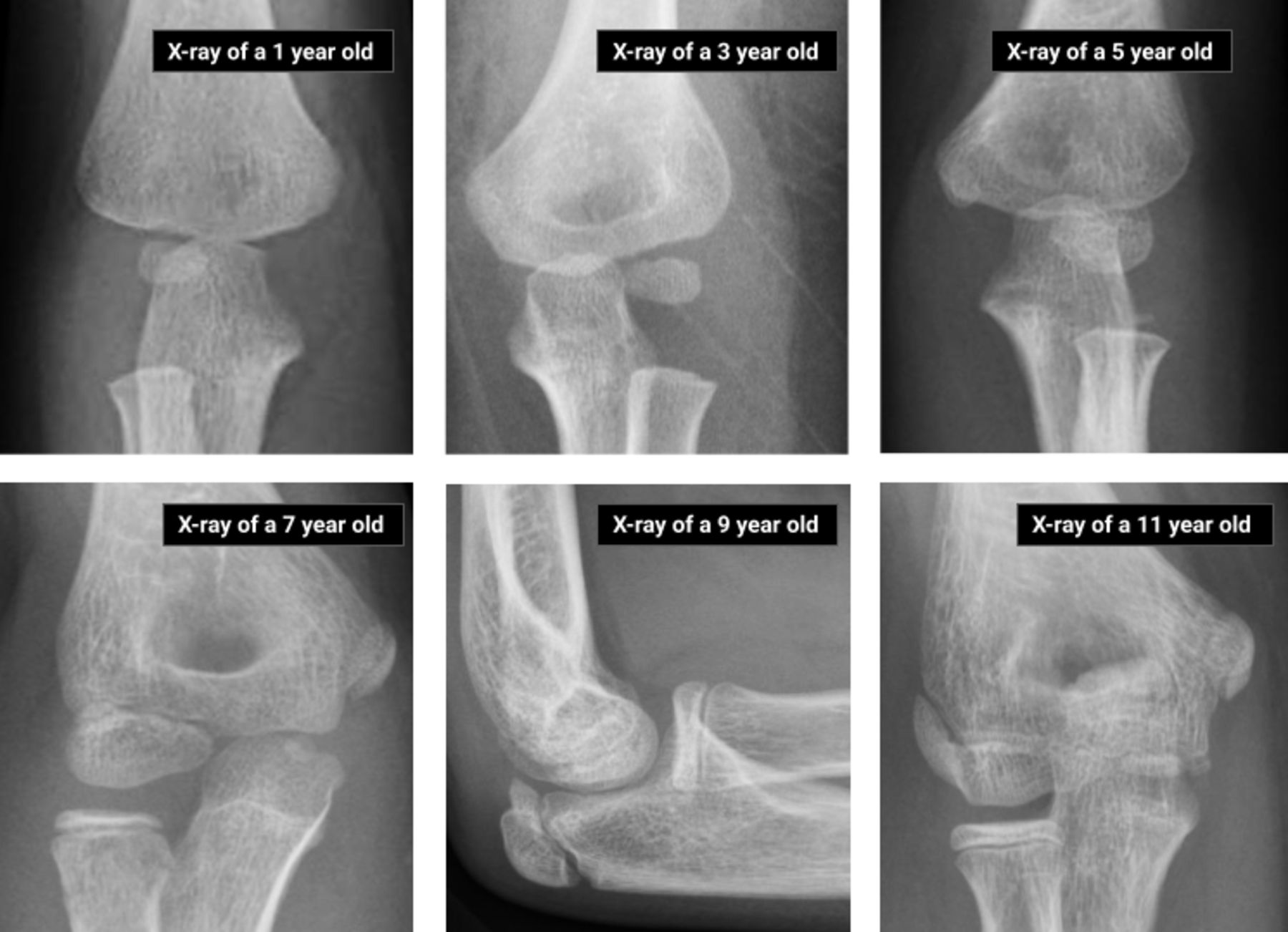 Xrays Elbow How To Approach The Pediatric Elbow EMRA Xrays Elbow How To Approach The Pediatric Elbow EMRA