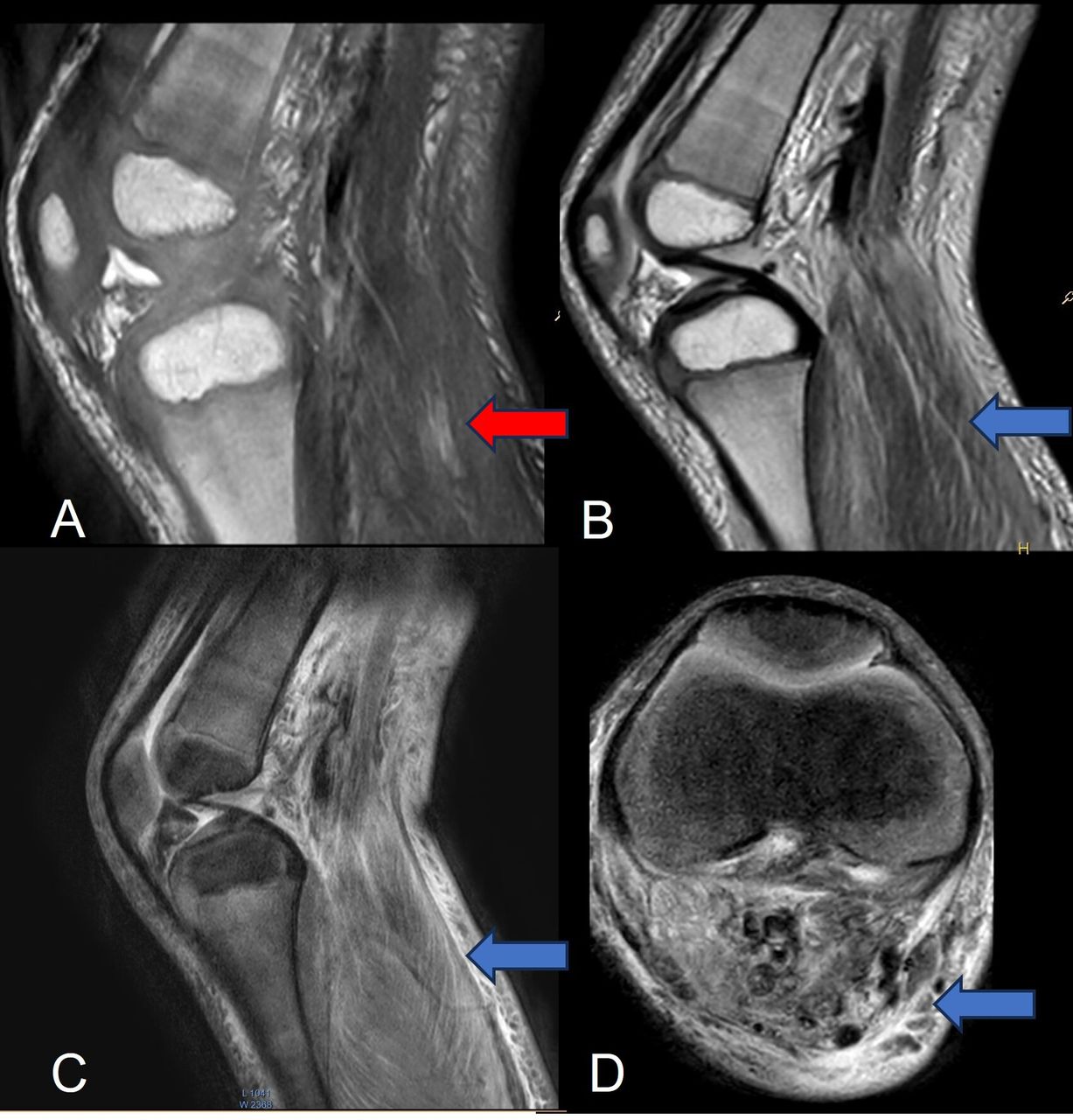 Stephen Rash Muscles Widespread rash, leg pain and increased muscle bulk | ADC Education ...