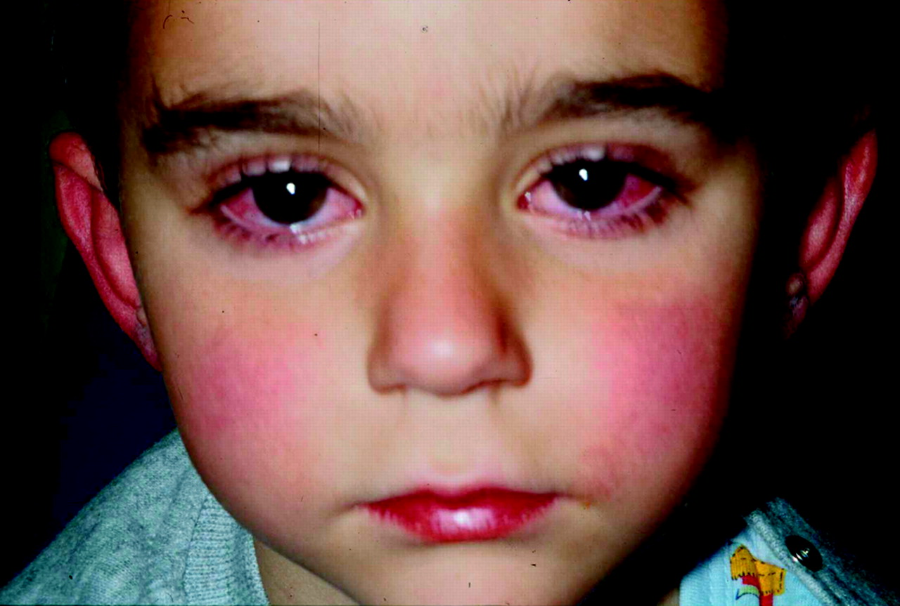 What Is Kawasaki Disease Pictures PPWBP